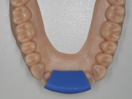 Memotain Retainer Model uebertragungskappe