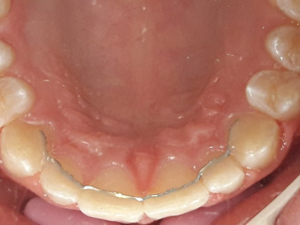 Memotain Retainer