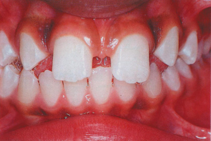 invisalign vorher