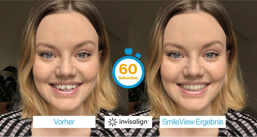 Invisalign Smile View