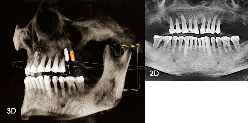 armin loew roentgen 3d implantate