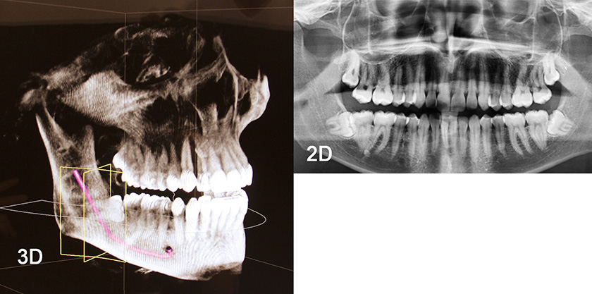 armin loew roentgen 3d weisheitszahn