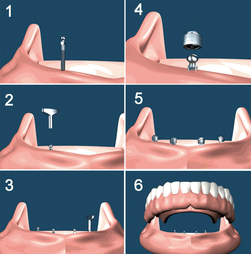 mini implantate MDI ablauf armin loew