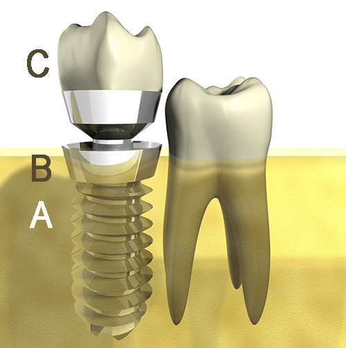 implantologie Fotolia 22404390 L