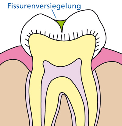 fissurenversiegelung 03